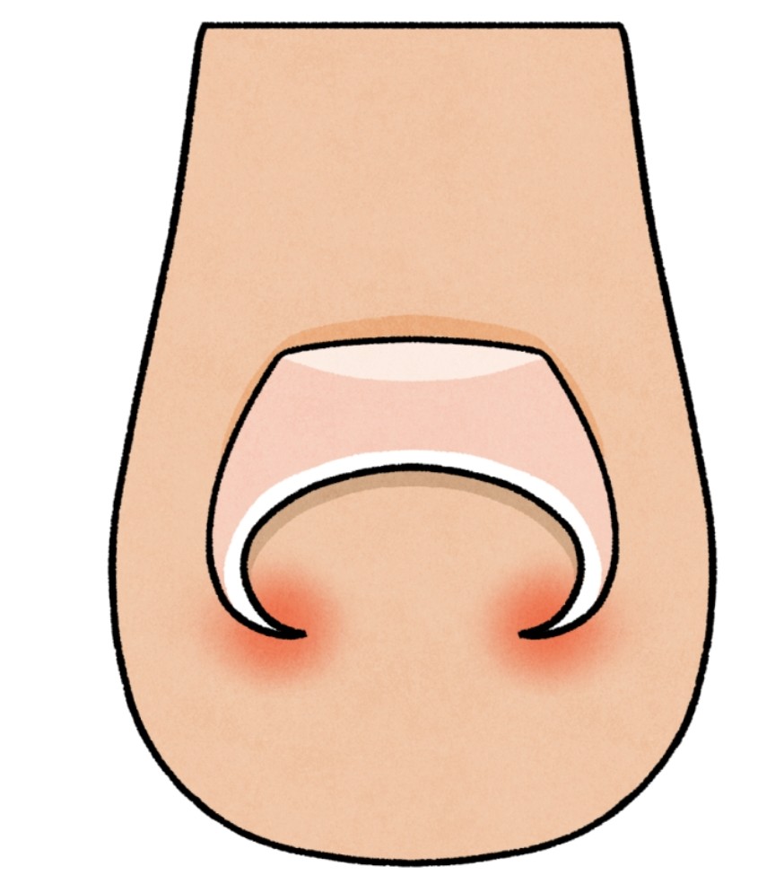 巻き爪の重症度の違い