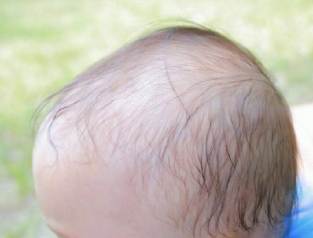 赤ちゃんの頭のゆがみ種類